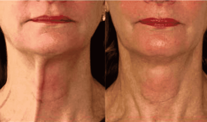 Before And After Images Of A Neck Rejuvenation Procedure Showing A Visibly Smoother And Tighter Neck Area Post-Treatment.
