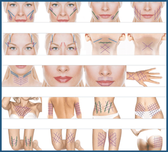 Diagram Showing The Insertion Of Novathreads During A Thread Lift Procedure In Skin Layers Including Epidermis, Dermis, And Subcutaneous Tissue.