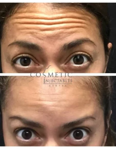 Before And After Photos Of A Patient'S Forehead And Frown Line Treatment Showing Significant Improvement