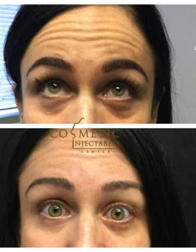 Patient'S Before And After Results From Forehead And Frown Line Treatment At Cosmetic Injectable Center