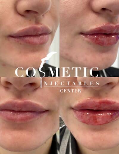 Progressive Results Of Lip Filler Treatment From Initial To Post-Procedure At A Cosmetic Injectables Center