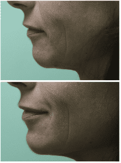 Profile view comparison before and after treatment for a receding chin, showing enhanced jawline contour and improved profile balance.