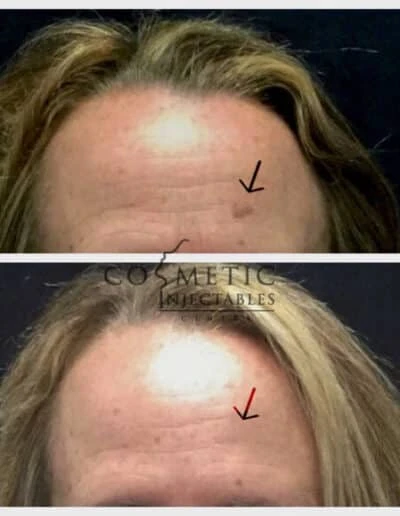 Before And After Effect Of Scalp Treatment For Hairline Enhancement At A Cosmetic Injectables Center