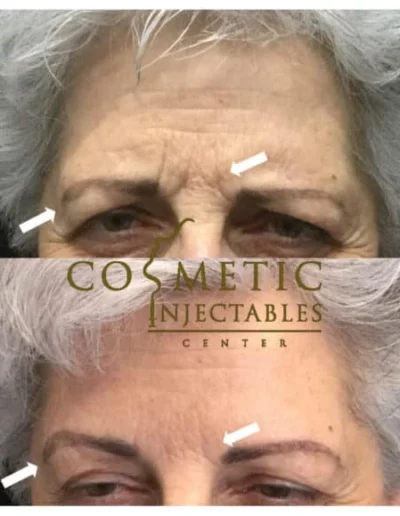 Before And After Results Of Forehead And Frown Line Treatment On A Senior Woman At Cosmetic Injectables Center