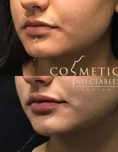 Side Profile View Before And After Cosmetic Enhancement With Guide Marks At A Cosmetic Injectables Center