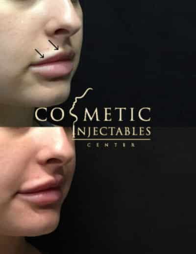 Side Profile View Before And After A Cosmetic Procedure With Guide Marks At A Cosmetic Injectables Center