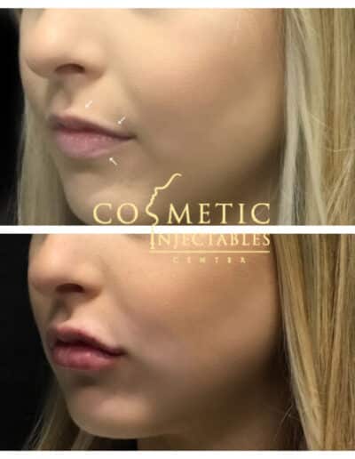 Before And After Side Profile View Of A Cosmetic Facial Procedure With Surgical Guide Markings At A Cosmetic Injectables Center