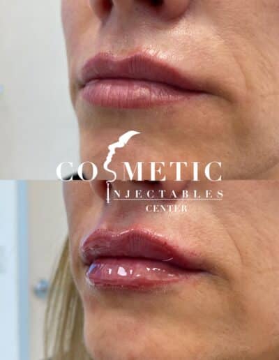 Side Profile Comparison Of Lip Enhancement Before And After Treatment At A Cosmetic Injectables Center