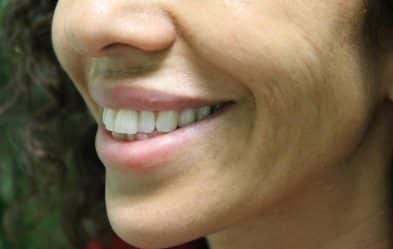 Close-Up Of A Smiling Person Showing Natural Lower Cheek Lines