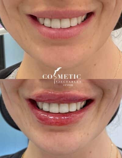 Smiling Patient'S Before And After Lip Enhancement Results From A Cosmetic Injectables Center