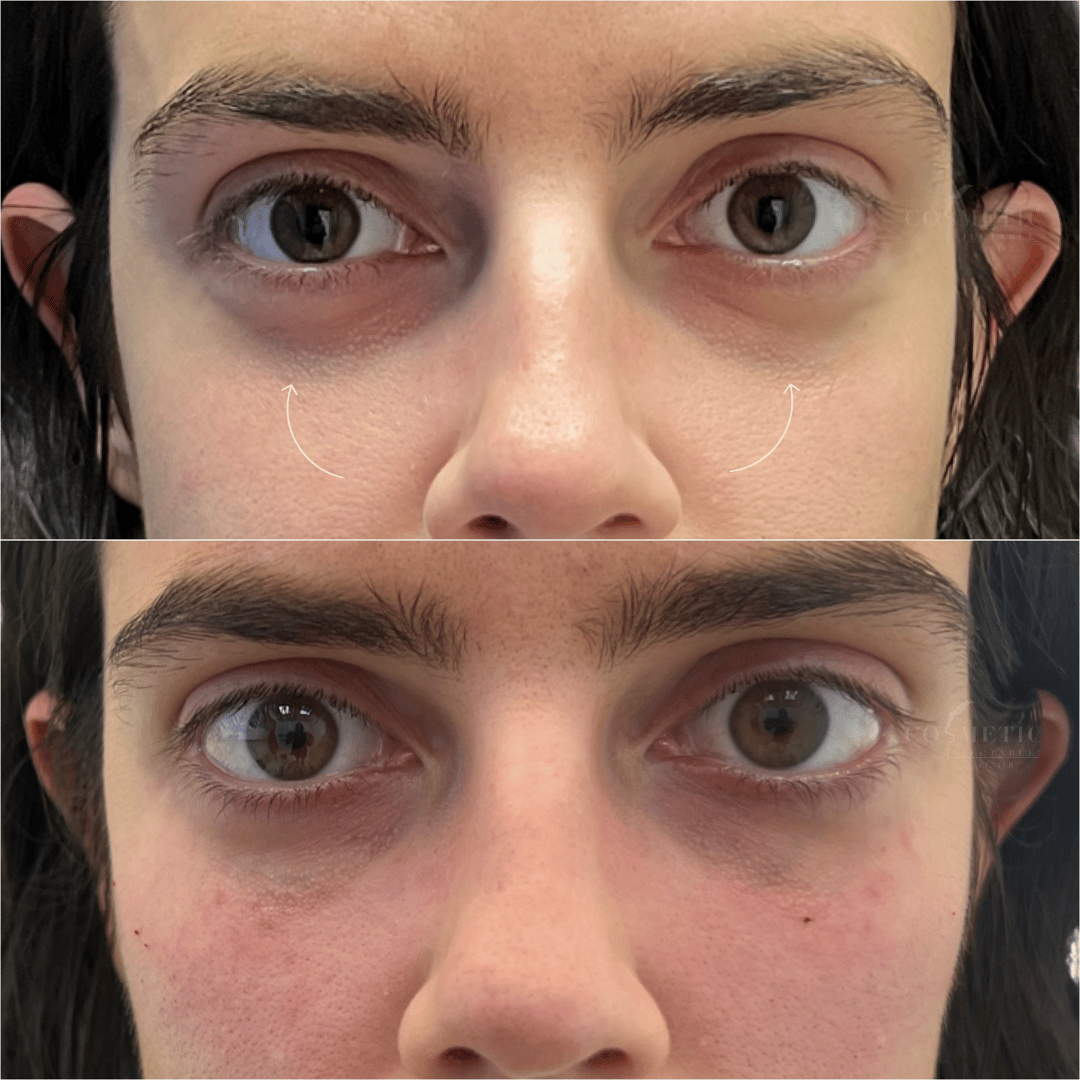 Comparison Of Under-Eye Area Before And After Non-Surgical Treatment Showing Reduced Dark Circles And Improved Skin Texture.