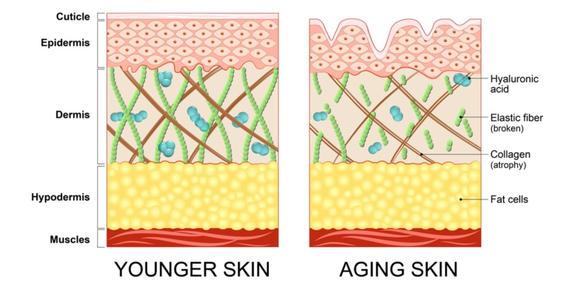 Comparison Of Younger And Aging Skin Showing Loss Of Collagen, Elastin, And Hyaluronic Acid