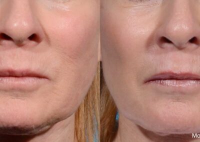 Before And After Comparison Of A Female Patient'S Chin And Lower Face Receiving Morpheus8 Skin Tightening And Rejuvenation Treatment.