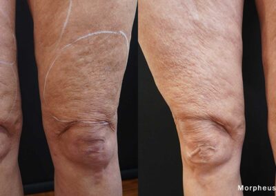 Before And After Images Displaying The Effects Of Morpheus8 Treatment On Thigh Skin Texture Improvement In A Patient.