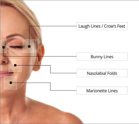 Face Diagram Highlighting Common Restylane Refyne Filler Treatment Areas Including Laugh Lines, Bunny Lines, Nasolabial Folds, And Marionette Lines.