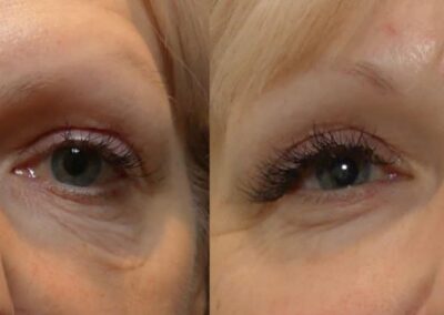 Morpheus8 Before And After Eyes Showing A Significant Reduction In Fine Lines And A Refreshed Appearance In The Eye Area Of A Female Patient.