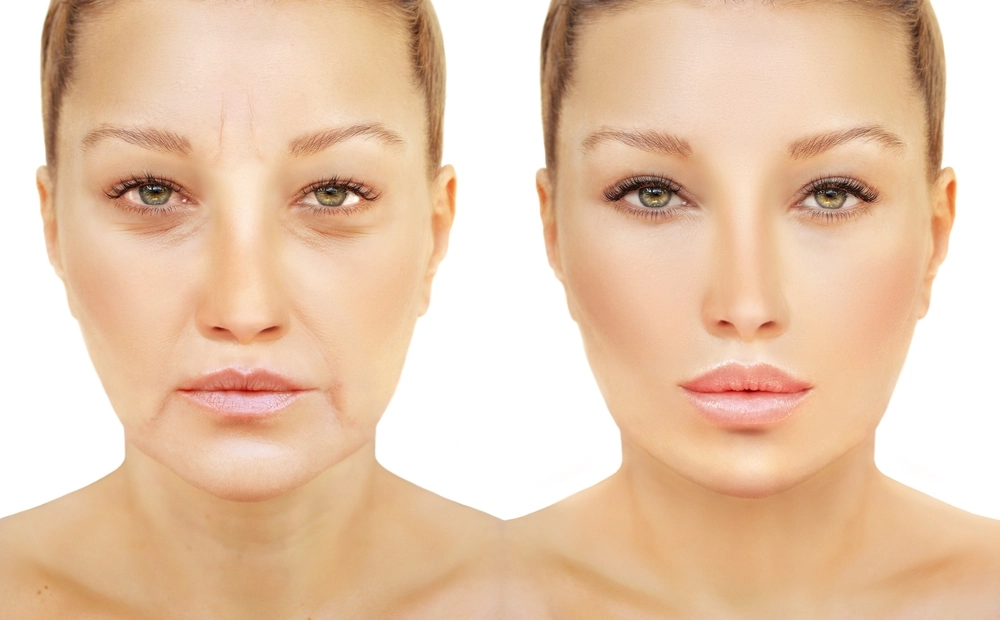 Before and after comparison of Xeomin treatment showing reduction in facial wrinkles and skin smoothing.