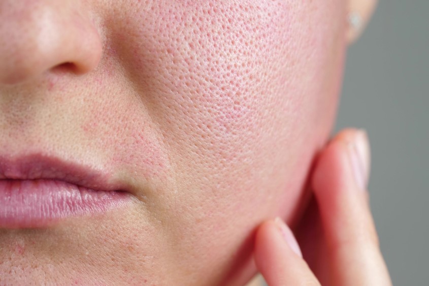 Close-up of woman's cheek with enlarged pores to evaluate for Laser Genesis candidacy