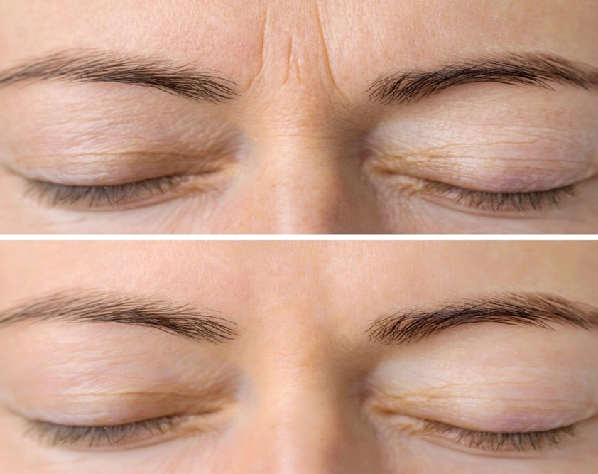 Before and after comparison of frown lines showing recovery following Jeuveau treatment for smoother skin.