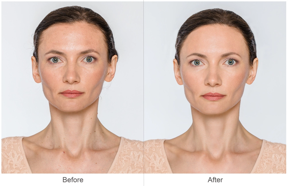 Before and after results of Laser Genesis skin treatment in Sherman Oaks