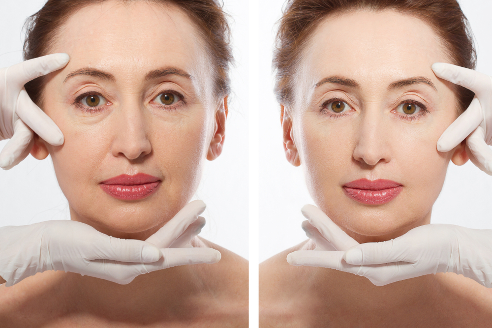 Comparison Of Rha 1 Treatment Areas Before And After On Middle-Aged Woman
