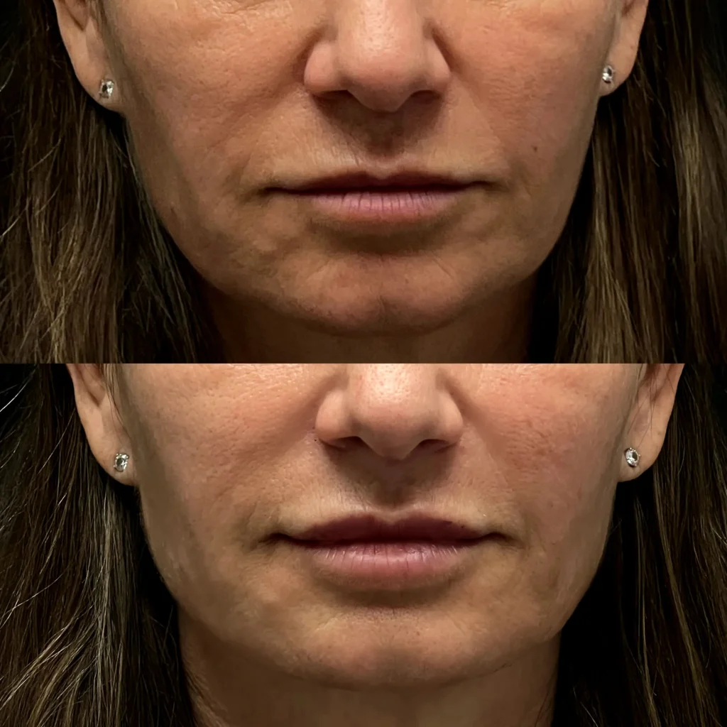 before after RHA2 thumbprints smile lines lip filler treatment | Cosmetic Injectables Center Medspa | Sherman Oaks, Los Angeles, CA