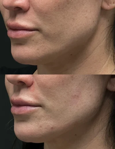 Rha4 Filler Before After Thumbprint Correction | Cosmetic Injectables Center Medspa | Sherman Oaks, Los Angeles, Ca