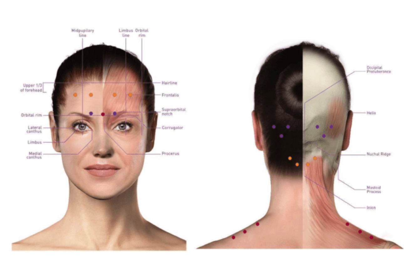 Botox injection points for migraine treatment on forehead, eyebrows, hairline, back of head, neck, and base of the skull.