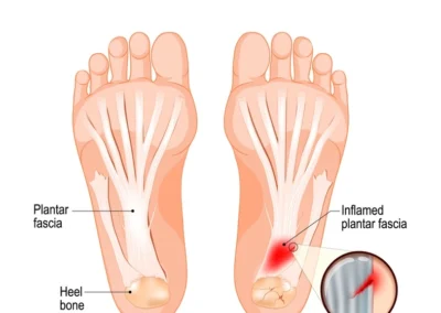 Comparison Of Healthy Foot And Plantar Fasciitis With Inflamed Ligament.