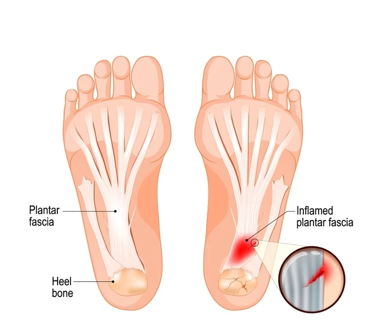 Botox for Plantar Fasciitis Sherman Oaks