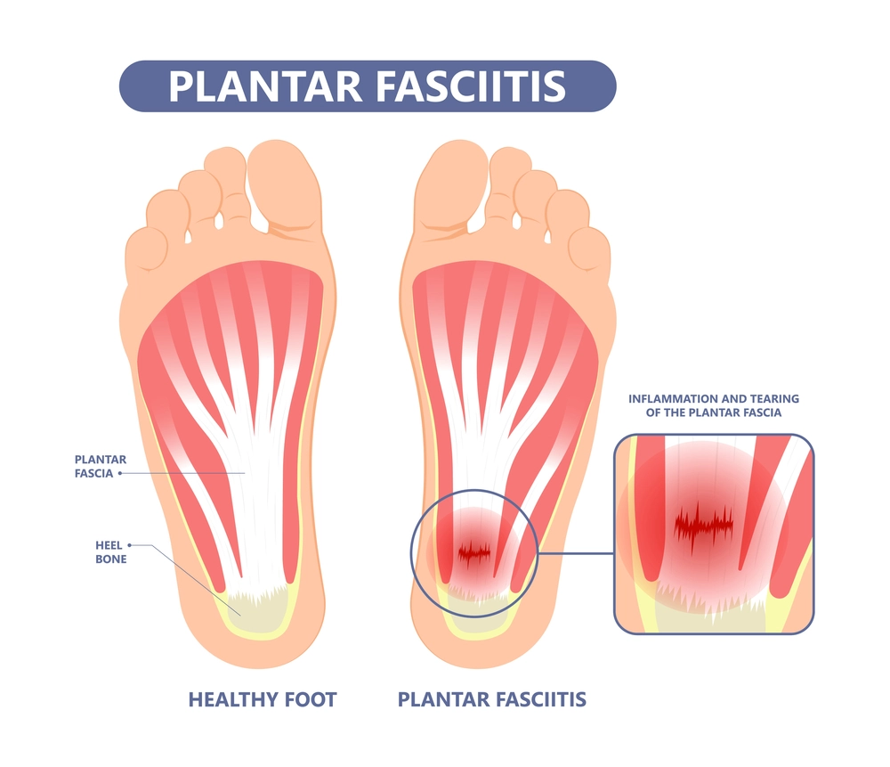 Illustration of healthy foot and plantar fasciitis with inflamed fascia.