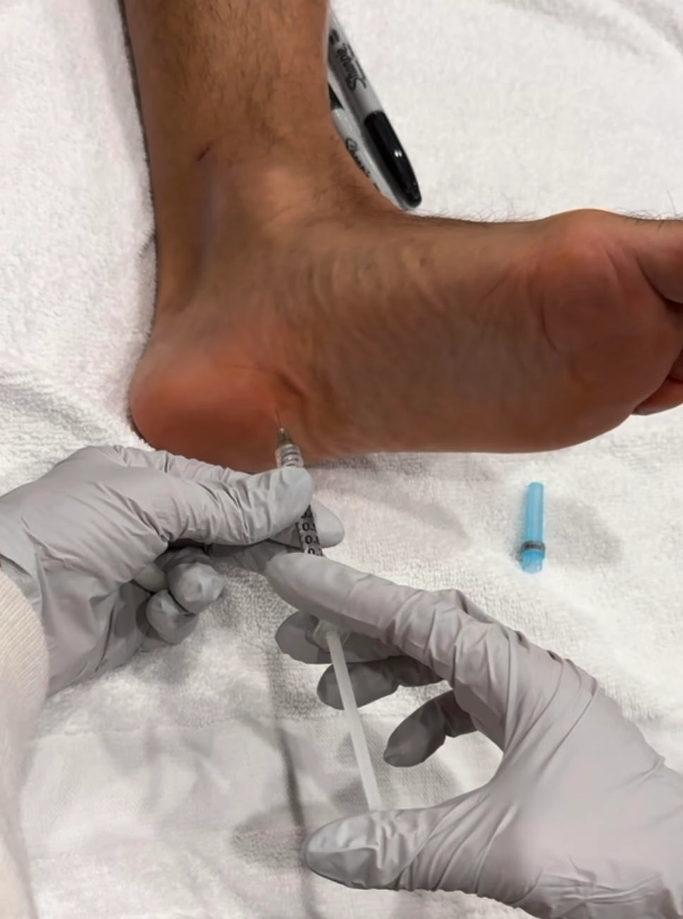 Botox injection administered during a Plantar Fasciitis treatment procedure.