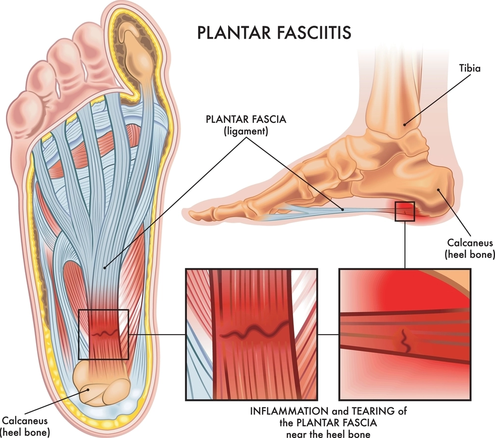 plantar fasciitis with labeled anatomy showing inflammation