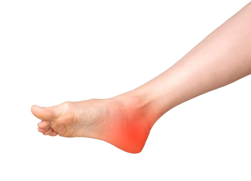 Bruising on the heel as a potential side effect of Botox injection.