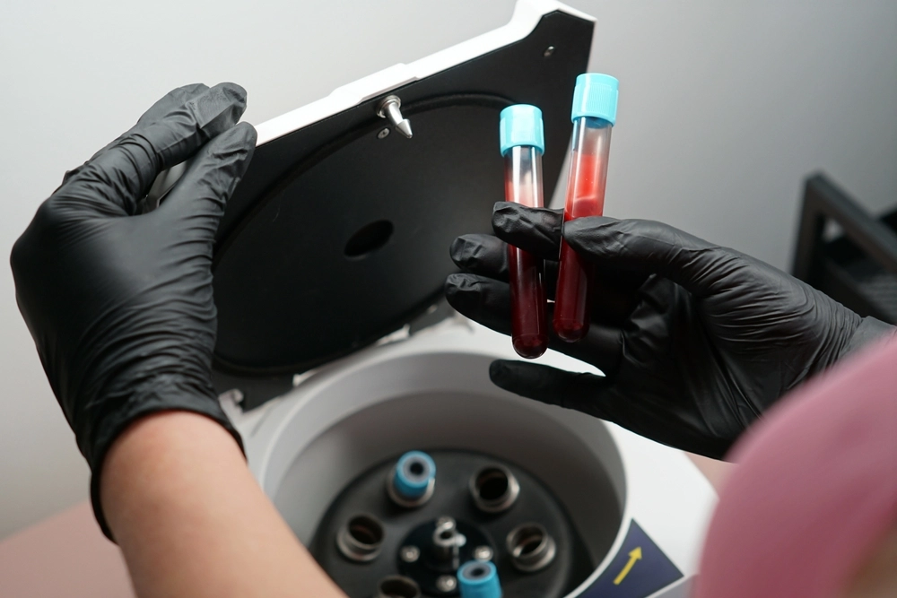 Preparation of blood samples for procedures similar to Botox treatment.