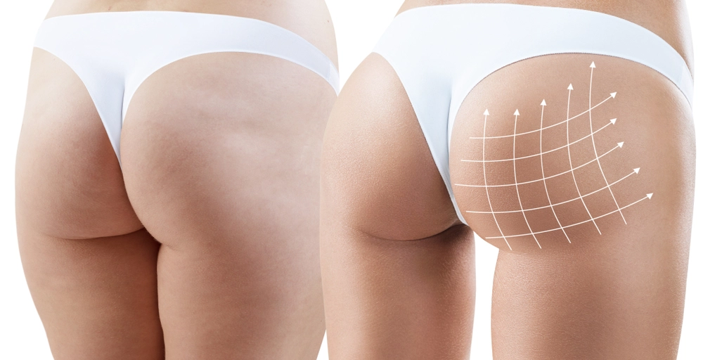 Sculptra Butt Lift Sherman Oaks