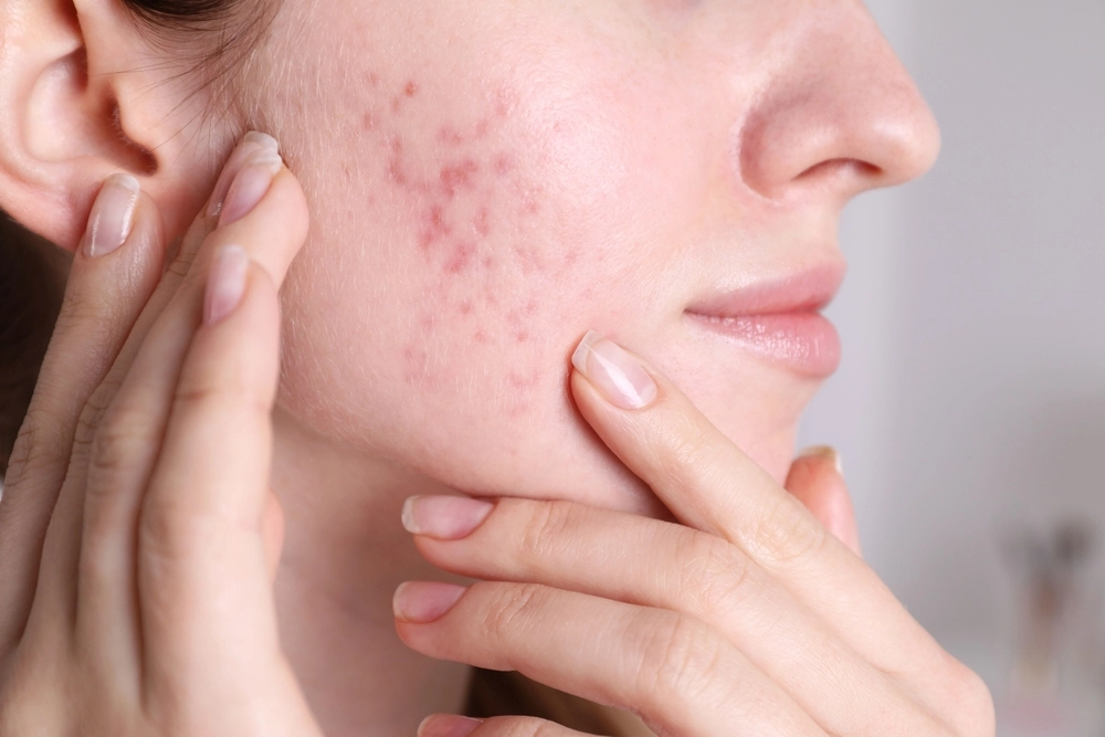 Acne & Its Hidden Meaning: What Your Breakouts Reveal About Your Skin?
