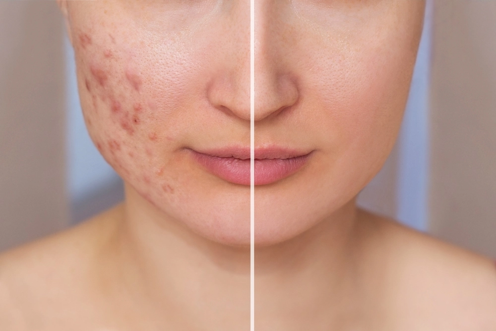 Side-by-side comparison of a woman's face before and after acne scar treatment, showing skin improvement.