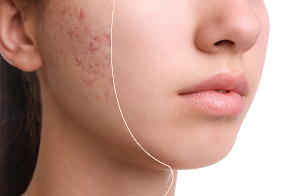 Acne Myths That Are Ruining Your Skin (And What Actually Works)