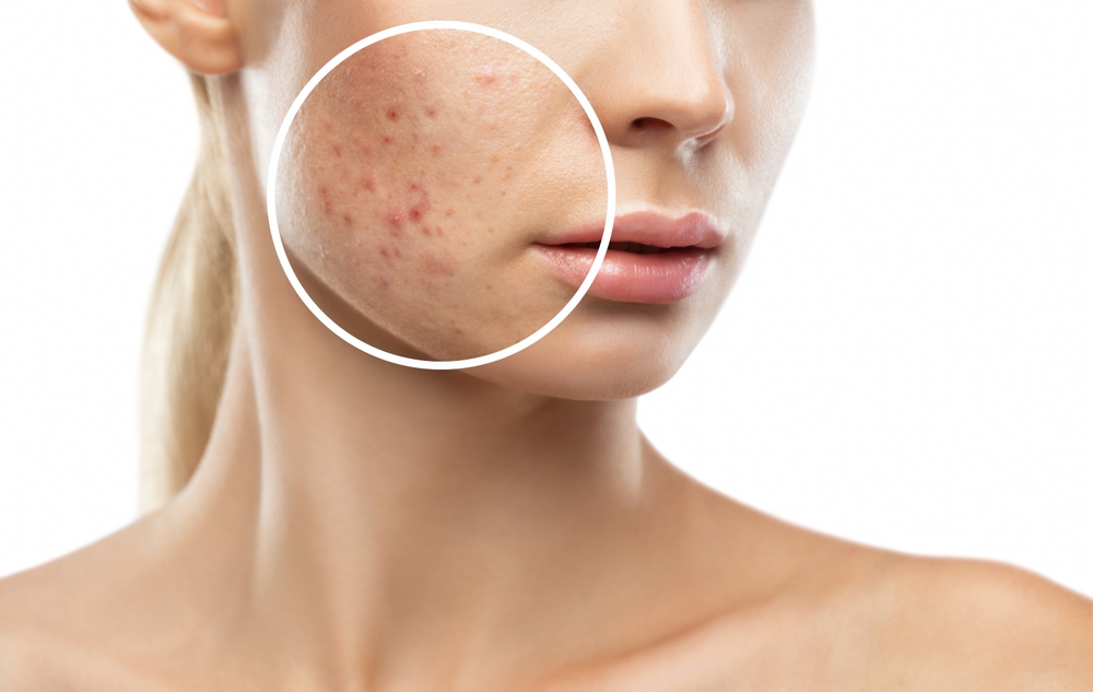 The Most Effective Acne Scar Treatments: What Really Works?