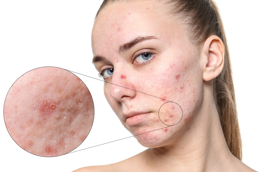 Best Dermal Fillers for Acne Scars: Which One is Right for You?