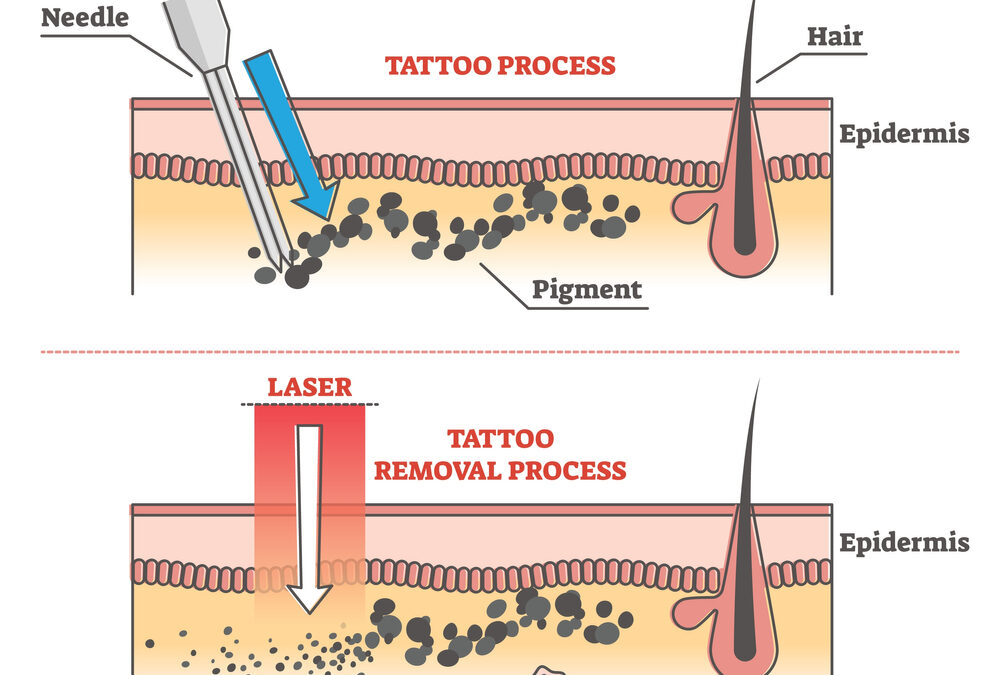 Tattoo Removal Sherman Oaks, Ca
