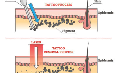 Laser Tattoo Removal Sherman Oaks, Ca