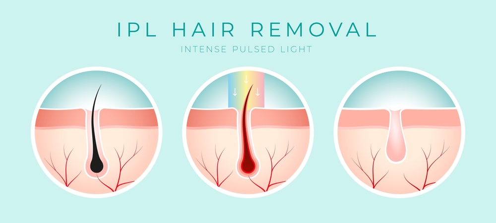 Before and after showcasing Belotero Balance benefits for smoother facial lines.