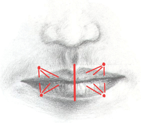 Four point injection technique