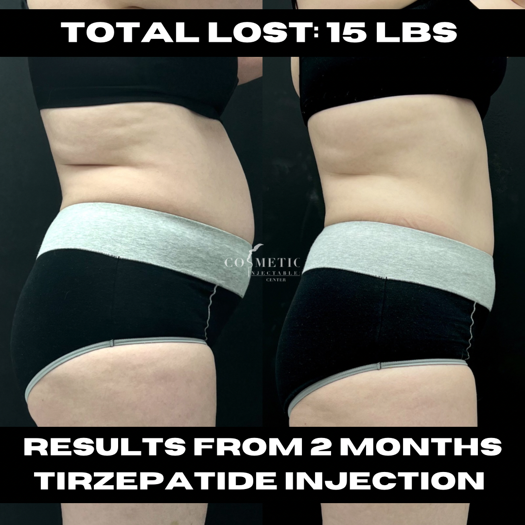 Untitled design 3 | Cosmetic Injectables Center Medspa | Sherman Oaks, Los Angeles, CA