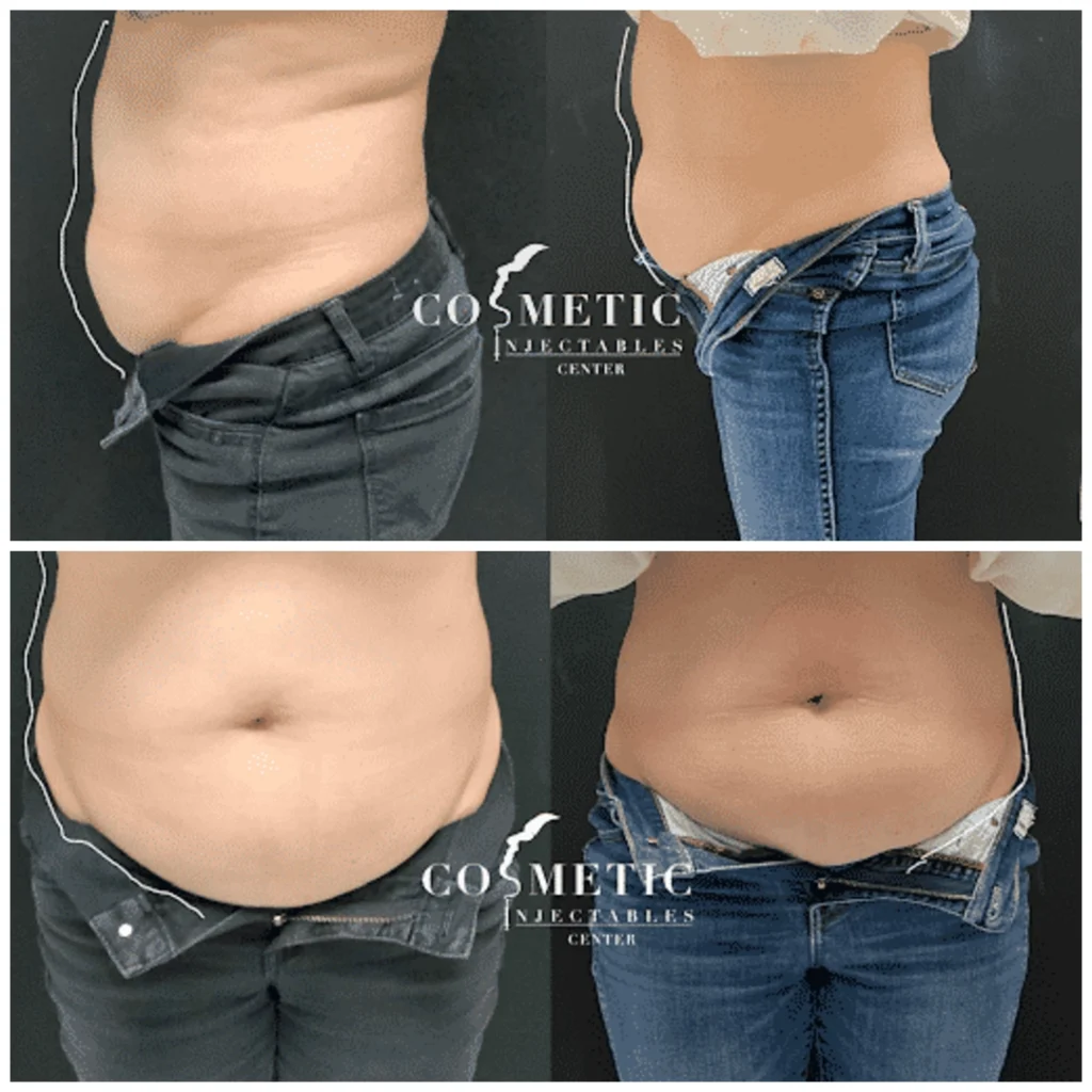 Emsculpt Neo Before and After Results