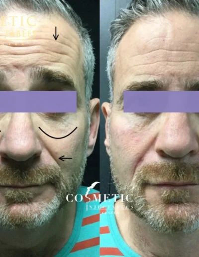 Rha 4 Smile Line Filler, Forehead Botox, And Restylane Eyelight Under Eye Before And After At Sherman Oaks Medical Spa