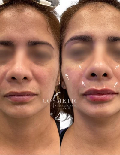 Rha 4 Cheek And Lip Filler Before And After Facial Balancing Results At Sherman Oaks Medical Spa