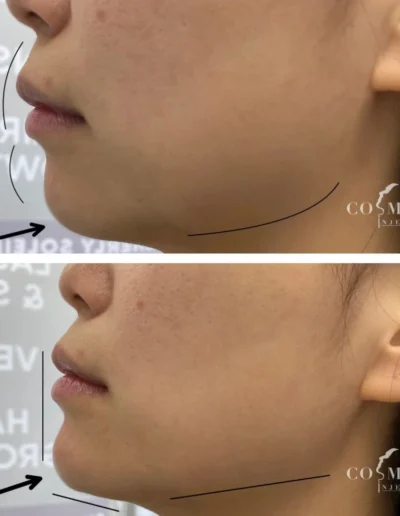 Rha 4 Chin Filler Before And After Results Improving Chin Contour At Sherman Oaks Medical Spa